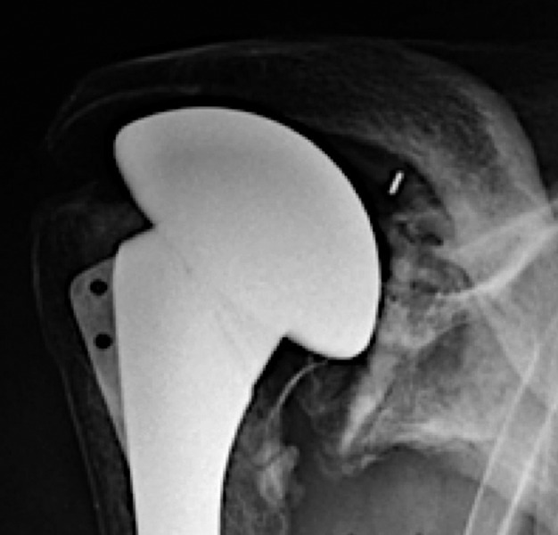 Fig. 3 
          Anteroposterior radiograph of a cemented,
all-polyethylene component, 15 years after surgery. Despite obvious
glenoid loosening with superior tilting of the component, the patient
has little pain and a functional shoulder.
        