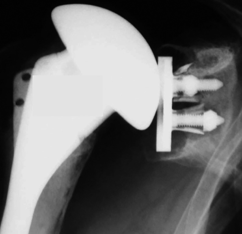 Fig. 4 
          Radiograph of a cementless, metal-backed
component five years after surgery, showing loosening due to anterior instability
secondary to insufficiency of subscapularis. Severe glenoid bone
loss was found at revision surgery with asymmetrical anterior polyethylene
wear.
        