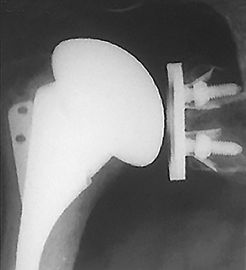 Figs. 5a - 5c 
          Radiographs taken a) preoperatively,
b) three years and c) nine years postoperatively showing complete
polyethylene wear with metal-on-metal contact without loosening
of a metal-backed glenoid component.
        