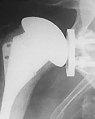 Figs. 5a - 5c 
          Radiographs taken a) preoperatively,
b) three years and c) nine years postoperatively showing complete
polyethylene wear with metal-on-metal contact without loosening
of a metal-backed glenoid component.
        