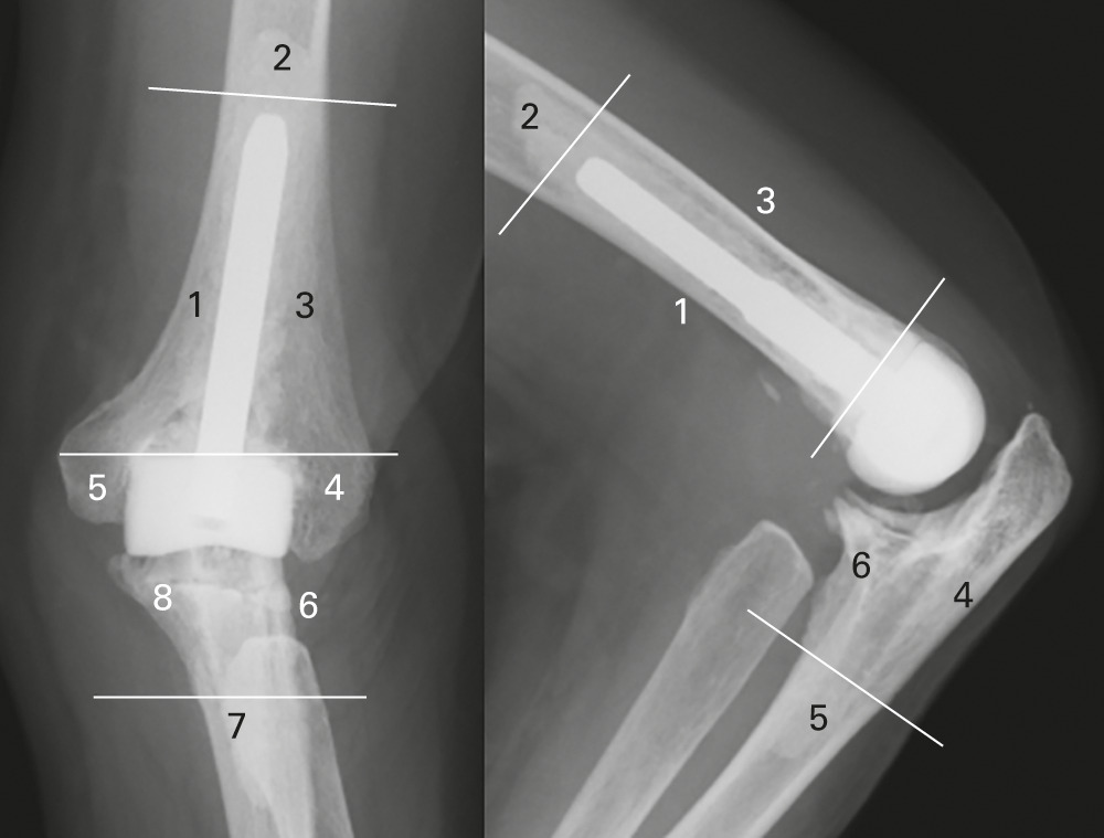Fig. 2 
            Anteroposterior and lateral radiographs
of the right elbow of a 54-year-old woman, 14 years after cemented
JACE total elbow arthroplasty (TEA) showing the location of radiolucent
zones.
          