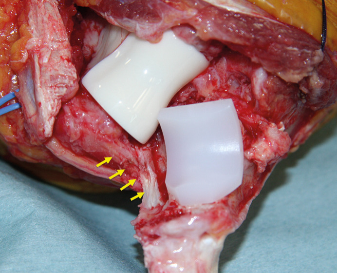 Fig. 4 
            The final setting of the components
of a J-alumina ceramic elbow (JACE) TEA with preserved medial collateral
ligament (MCL; indicated by arrows).
          
