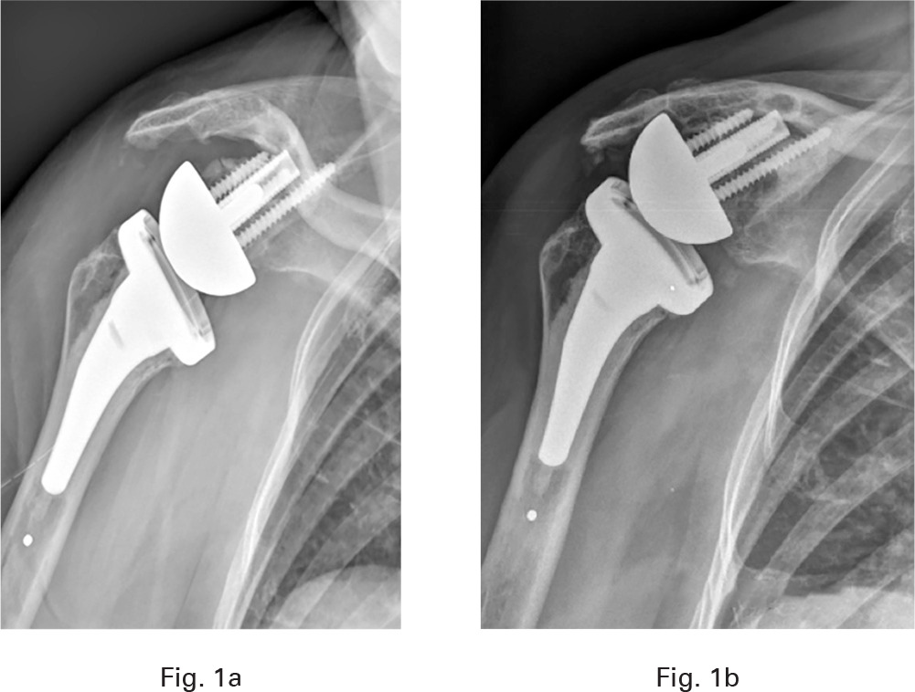 Fig. 1 
          a) Postoperative radiograph of a right bony-increased offset reverse shoulder arthroplasty (BIO-RSA) with inferior inclination of the baseplate. At two weeks, an acute migration was observed. b) One-year follow-up radiograph demonstrating a secondary stabilization of the prosthesis under the acromion.
        