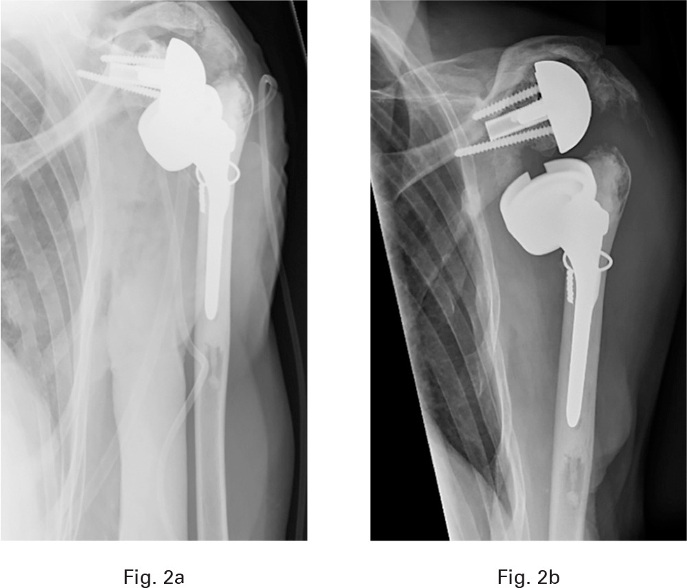 Fig. 2 
          a) Immediate postoperative anteroposterior radiograph of a left bony-increased offset reverse shoulder arthroplasty (BIO-RSA). b) Three months postoperative anteroposterior radiograph of the same patient showing that glenoid loosening appeared at the native scapula/autograft interface.
        