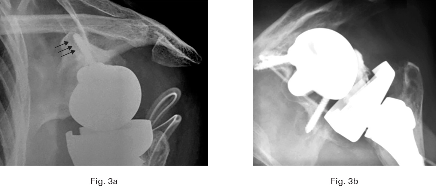 Fig. 3 
          a) Immediate postoperative axial view of a left BIO-RSA. Radiolucent lines (arrows) illustrate non-integration of the glenosphere. b) Two-year follow-up radiograph of the same patient with clear signs of glenoid loosening without secondary migration.
        
