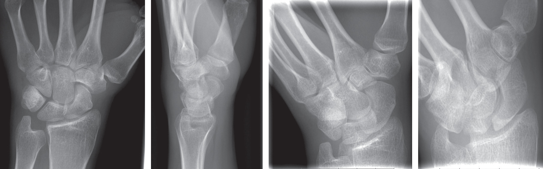 Fig. 1 
          A scaphoid series of a patient with negative radiographs who was randomized to the intervention (MRI) arm of the trial.
        