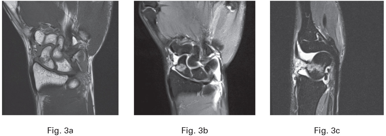 Fig. 3 
          Imaging of a patient with fracture of the waist of the scaphoid showing the abbreviated MRI for: a) coronal T1; b) coronal proton density fat supressed (PDFS); and c) sagittal short T1 inversion recovery (STIR).
        