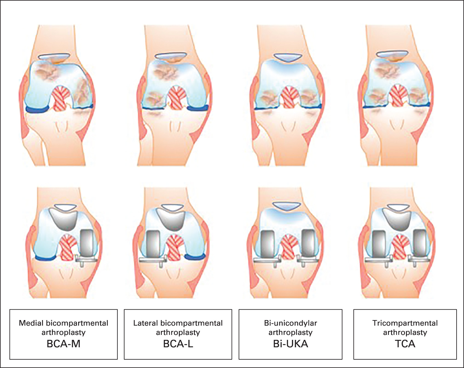 Fig. 2 
          Classification of combined partial knee arthroplasty (CPKA).
        
