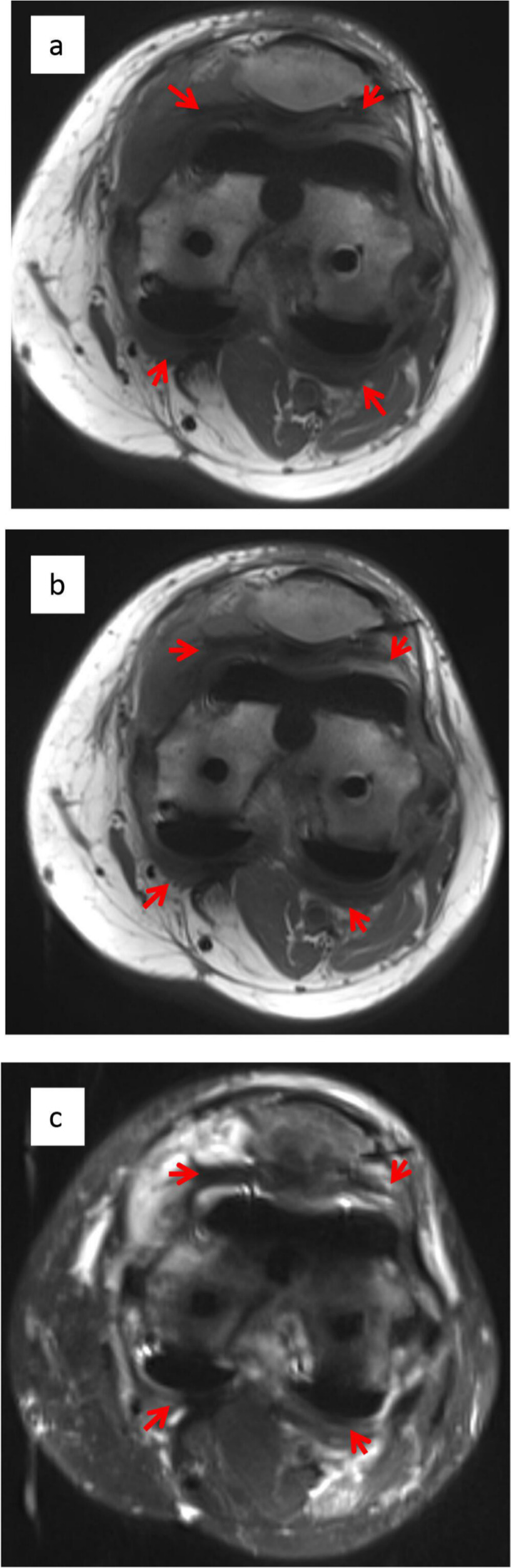 Fig. 1 
          Intra-articular scarring in a patient with a clinical diagnosis of fibrosis. SEMAC images of a fibrotic post-total knee arthroplasty patient demonstrate significant fibrotic tissue in the posterior and anterior compartments (arrows): (a) Axial T1 pre-contrast, (b) axial T1 post-contrast, and (c) axial fat-saturated images.
        