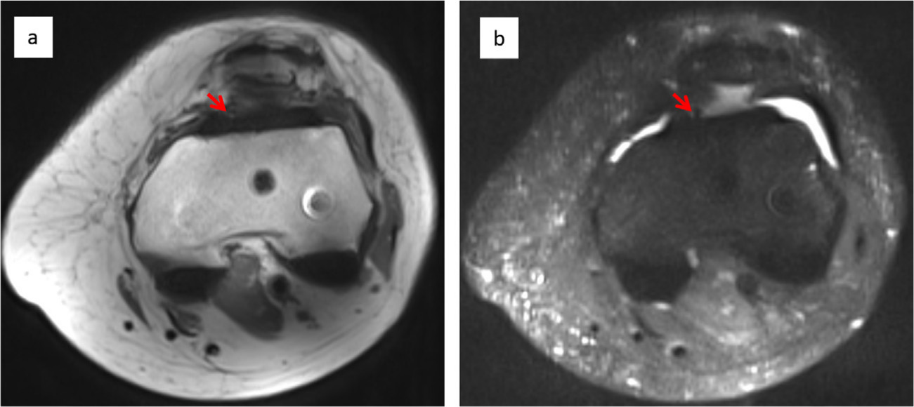 Fig. 2 
          No fibrotic tissue in a healthy TKA. Axial T1 post-contrast (a) and fat-saturated (b) images of a healthy total knee arthroplasty, showing minimal fibrotic tissue in anterior and posterior compartments. A small area of fibrotic tissue detected in the anterior-medial suprapatella compartment is identified (arrows).
        