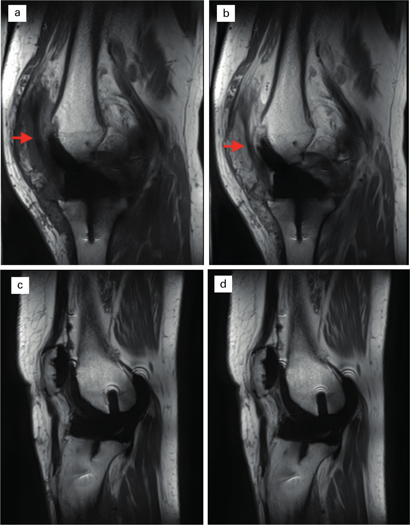 Fig. 3 
          Fibrotic tissue in the infrapatella region. Sagittal pre- and post-contrast T1 images comparing fibrotic patient (a) and (b) with non-fibrotic (c and d). Fibrotic tissue (arrows) is identified in the infrapatella region in a and b, extending underneath the patella between the infra- and suprapatella pouches. No such band of tissue is seen in a healthy TKA (c and d).
        