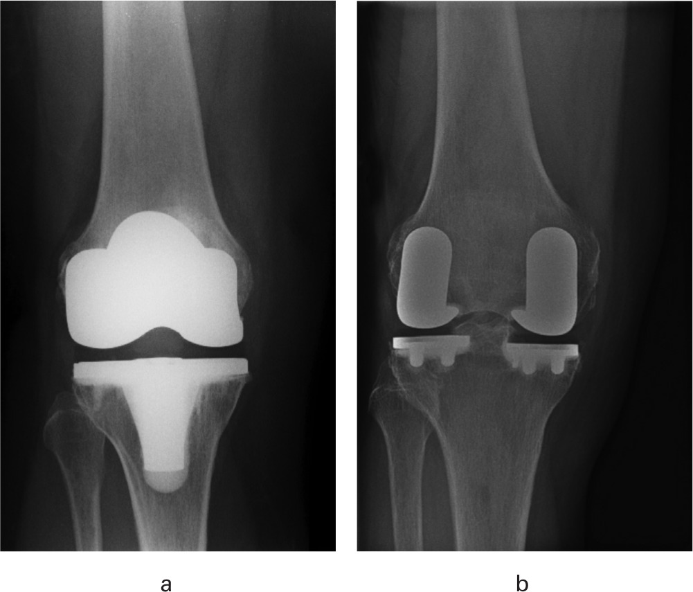 Fig. 2 
          Anteroposterior radiographs of a) total knee arthroplasty using a NexGen LPS-Flex, and b) bi-unicompartmental knee arthroplasty using the medial and lateral Restoris compartmental implants.
        
