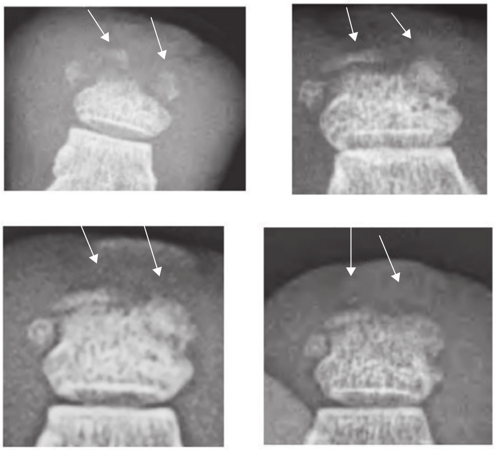 Fig. 5 
            Radiographs of ulcerated toe over the course of treatment showing reossification of the toe. Radiographs taken on a) April 2015; b) July 2015; c) June 2015; and d) September 2015. Arrows indicate areas of reossification from photo (a) to photos (b-d). Adapted from Fish et al.34
          