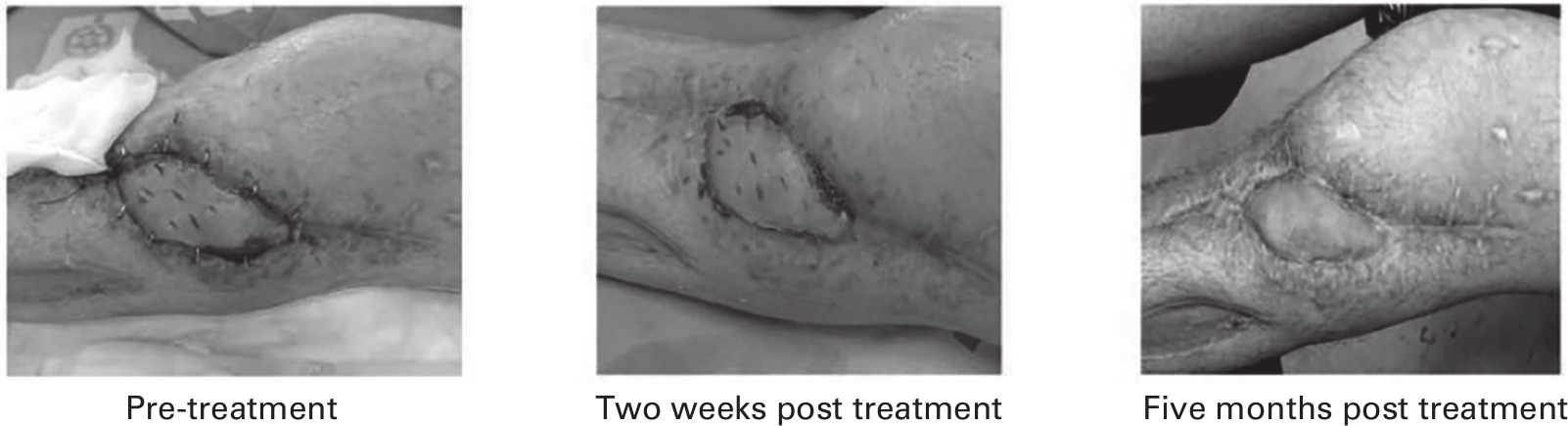 Fig. 6 
            Wound healing of a patient as induced by phage treatment. Before treatment, the flap edges did not heal well, with dehiscence and evisceration. By two weeks after treatment, the wound had completely healed and there was no dehiscence and evisceration of flap. By five months after treatment, complete healing of the wound was observed. Adapted from Nir-Paz et al.40
          