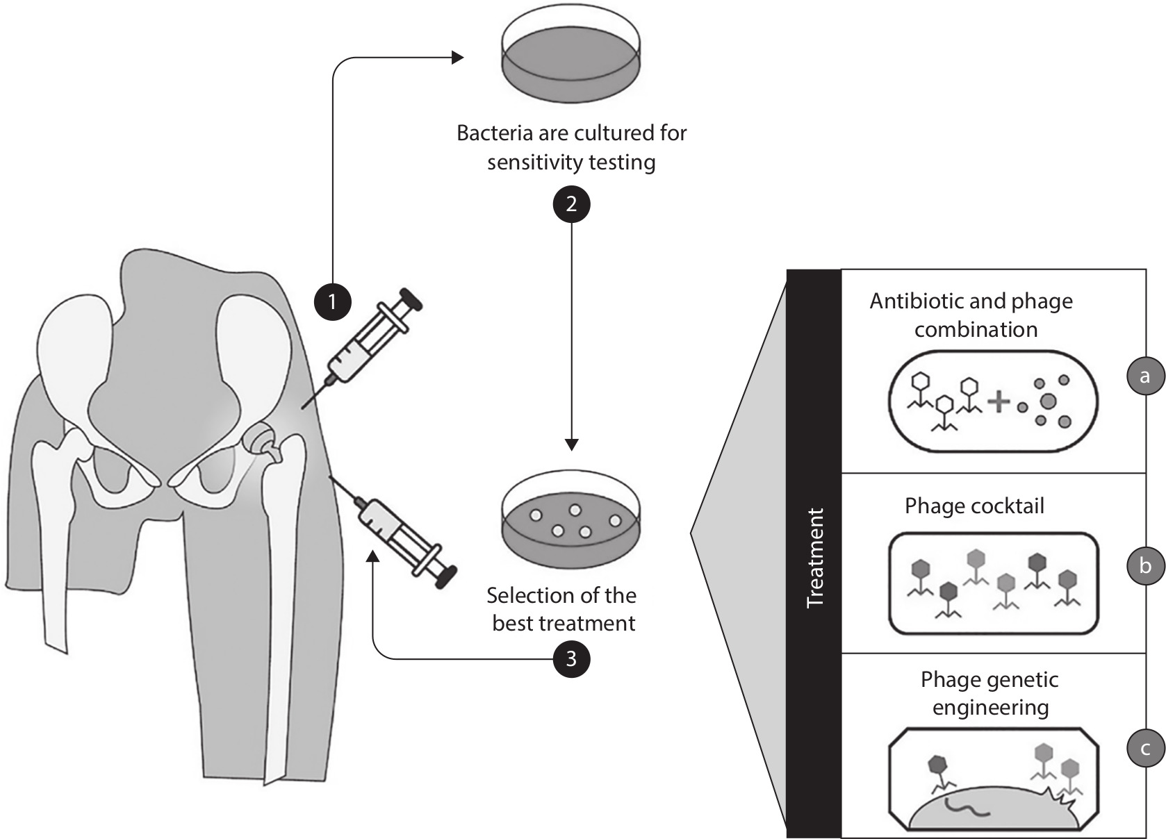 Fig. 7 
            Personalized combinatorial phage therapy. Various treatments for periprosthetic joint infection can be developed using a combination of either phages and antibiotics, phage cocktail, or engineered phages in order to create personalized therapy. Adopted from Romero-Calle et al.45
          