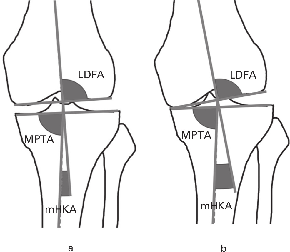 Fig. 1 
              a) Lateral distal femoral angle (LDFA), medial proximal tibial angle (MPTA), and mechanical hip-knee-ankle angle (mHKA) in a knee with preserved joint space and mild constitutional varus alignment. b) The same knee following degenerative loss of medial joint space, showing a change in mHKA (with shift to further varus) but no change to LDFA and MPTA.
            