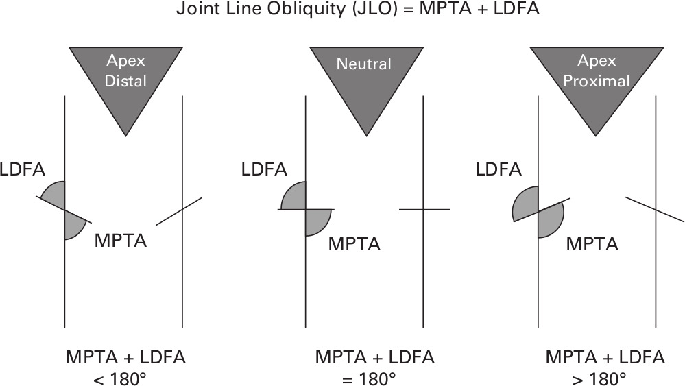 Fig. 3 
            Use of medial proximal tibial angle (MPTA) and lateral distal femoral angle (LDFA) to indicate joint line obliquity (JLO).
          
