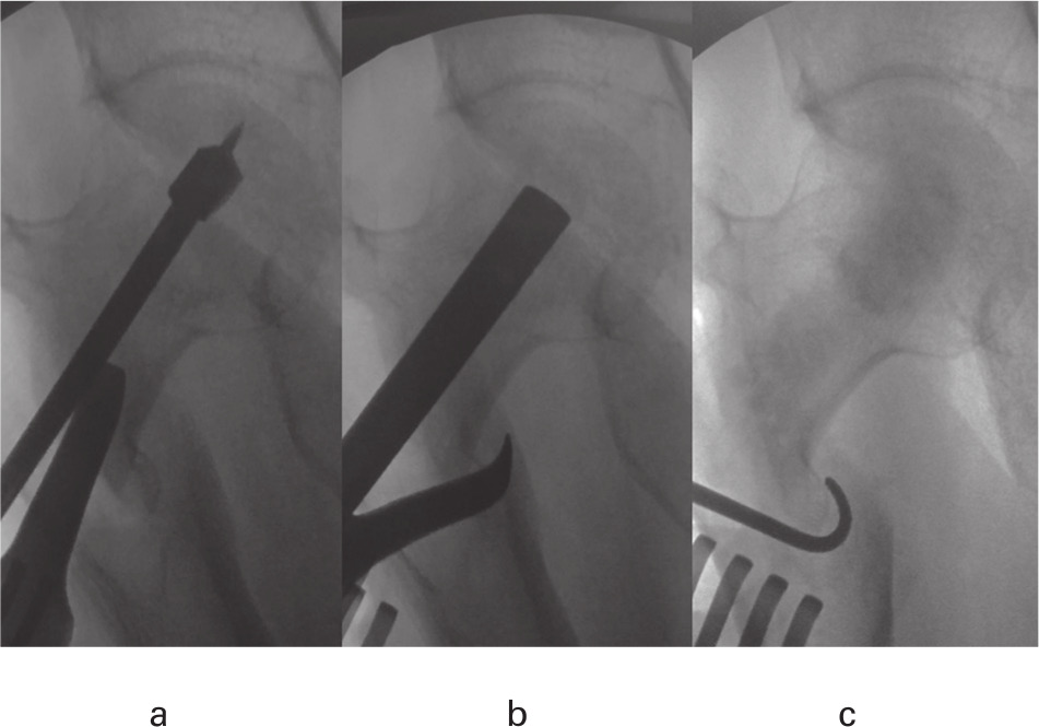 Fig. 2 
            a) An osteotomy guide pin was placed in the centre of the necrotic area during fluoroscopy and a bone hole was drilled over the guide pin. b) Impaction of autogenous bone was performed in the necrotic area and the shape of the femoral head was evaluated to prevent puncture into the joint. c) The procedure was completed by impacting the beta-tricalcium phosphate grating after the autogenous bone.
          