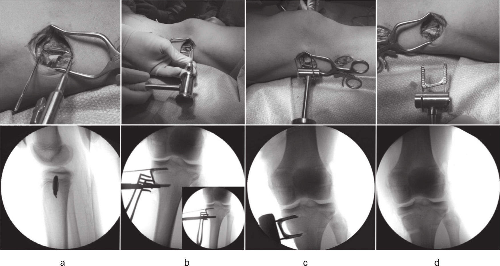 Fig. 2 
            Explantation of a rigid staple (same patient shown in Figure 7). a) Kirschner wire threaded into the staple prongs after exposure followed by b) chisel insertion to clear the interface and c) extraction with sliding hammer to d) fully remove the staple without residual bone.
          