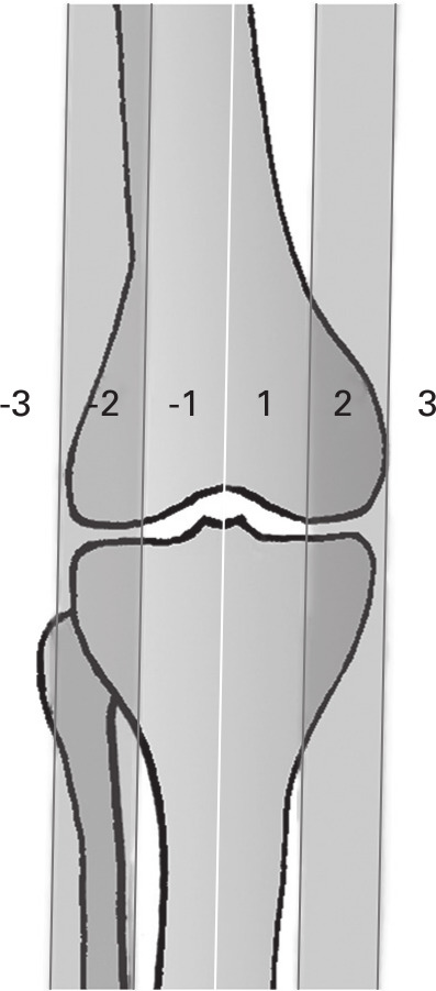 Fig. 3 
            Zones of the mechanical axis. The neutral mechanical axis (white line) divides the central knee joint area in the frontal plane into zones 1 and -1. Zones 2 and 3 are the more medial (varus), and zones -2 and -3 are the more lateral (valgus) zones, their boarders are tangent to the medial and lateral femoral condlyes.
          