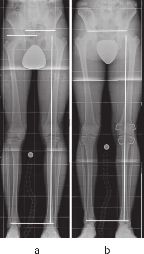 Fig. 7 
            Radiographs before and after treatment with rigid staples (same patient shown in Figure 2). Left: 4.2 cm leg length discrepancy in a male patient at 11 years and one month. Right: Corrected leg length after three years and seven months at 14 years and eight months of age.
          