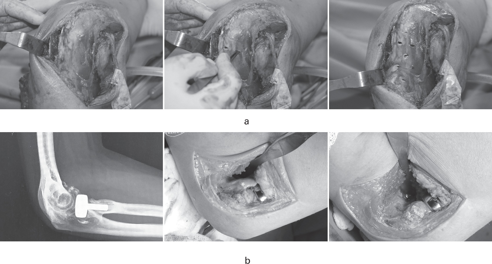 Fig. 2 
          The management of tethers and blocks in open elbow arthrolysis. a) Posterior tether release: contracted triceps pie-crusting technique. Multiple stab incisions are made in the triceps tendon in the medial-to-lateral and distal-to-proximal directions. b) Removal of an anterior block: radiograph shows anterior heterotopic ossification (HO). An irregularly shaped HO (*) originating from the distal humerus can be seen anteriorly. All figures are used with permission of the owner. All rights reserved (Sun et al. Bone Jt Open. 2020;1(8):576 to 584).
        