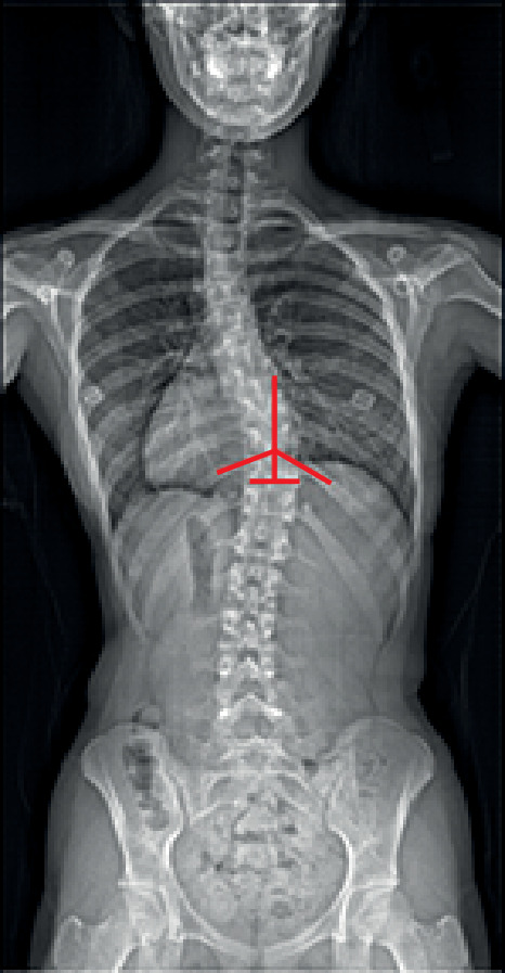 Fig. 2 
            The rib-vertebral angle (RVA) is formed between the longitudinal axis of the apical thoracic vertebra and corresponding rib on the convex and concave sides of the curve. A perpendicular line is drawn at the midpoint of the lower endplate of the apical vertebra. Another line is drawn from the midpoint of the head to the midpoint of the neck of the rib. The rib line is extended medially to intersect with the perpendicular line to make the RVA.
          