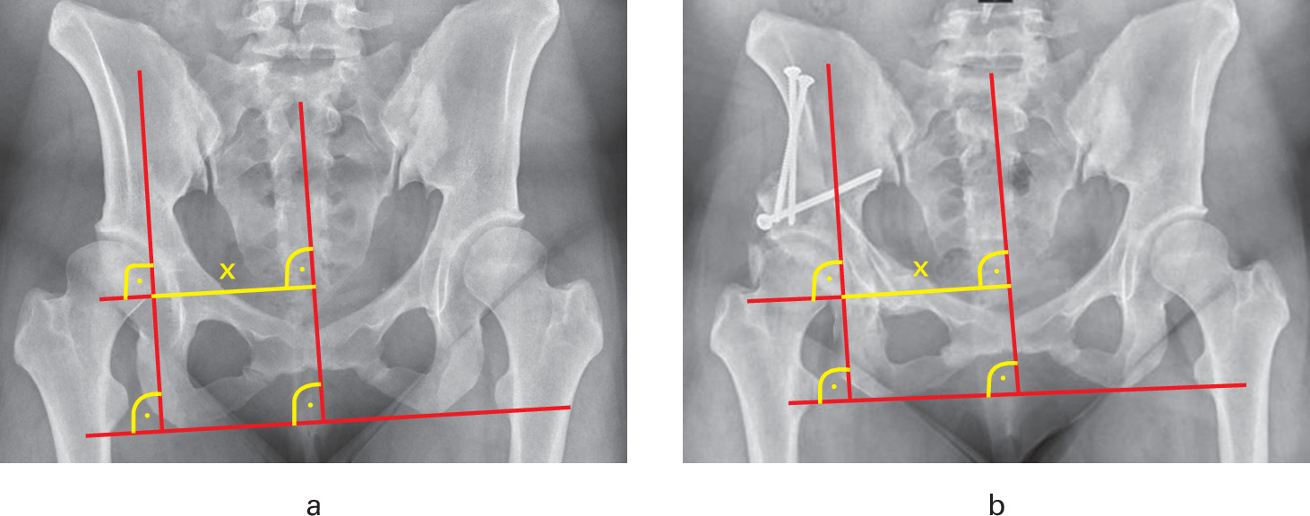 Fig. 1 
          Medialization of the hip a) pre- and b) postoperatively, showing the line connecting the midline of the body and the medial aspect of the femoral head (x).
        
