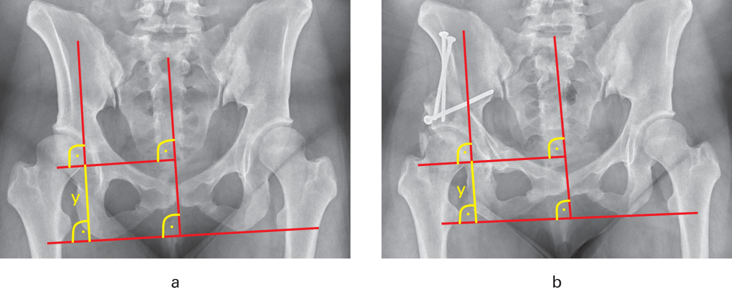 Fig. 2 
          Distalization of the hip a) pre- and b) postoperatively, showing the line connecting the baseline and the lowest aspect of the femoral head (y).
        