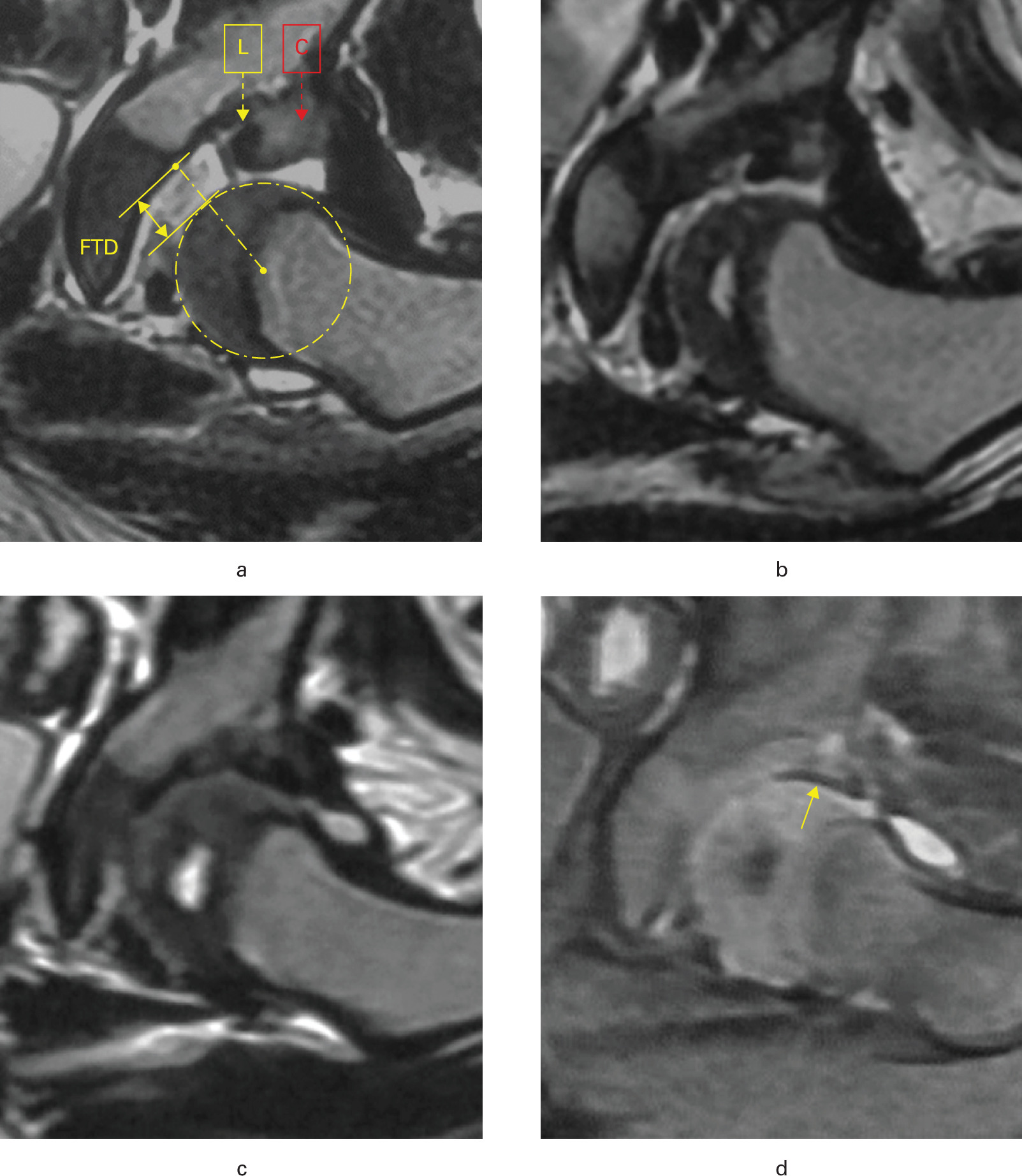 Fig. 1 
            MRI scans in the coronal plane of a 13-month-old female patient with left developmental dysplasia of the hip treated by closed reduction and spica cast immobilization. a) Immediately after the initial reduction, incomplete reduction (femoral head to tricartilage distance (FTD) = 6.68 mm) and inverted labrum-acetabular cartilage complex (LACC) are seen on the T2 weight image (T2WI) scan; FTD was calculated by the distance between the centre of the femoral head and the lateral edge of the triradiate cartilage minus the radius of the femoral head, and the morphology of the LACC was determined by the direction of acetabular labrum (low signal intensity, as shown by the yellow arrow) and cartilage (medium signal intensity, as shown by the red arrow). b) At the end of first cast with 67 days’ immobilization, decreased FTD and inverted LACC are seen on the T2WI scan. c) At the end of second cast with a total of 171 days of immobilization, concentric reduction with complete reduction and congruent cartilage are seen on the T2WI scan. d) A residual inverted labrum was found between the femoral head and acetabular cartilage on proton density-weighted imaging scan as shown by the yellow arrow.
          