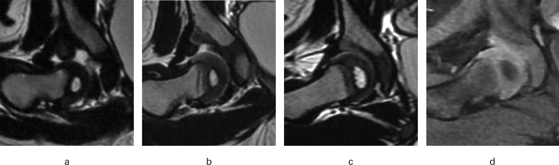 Fig. 2 
            MRI scans in the coronary plane of a 15-month-old female patient with right developmental dysplasia of the hip. a) Immediately after initial reduction and b) at the end of first cast with 76 days of immobilization, an everted-incongruent labrum-acetabular cartilage complex is seen. c) At the end of second cast with 157 days of immobilization, concentric reduction was obtained and d) no residual labrum was found.
          