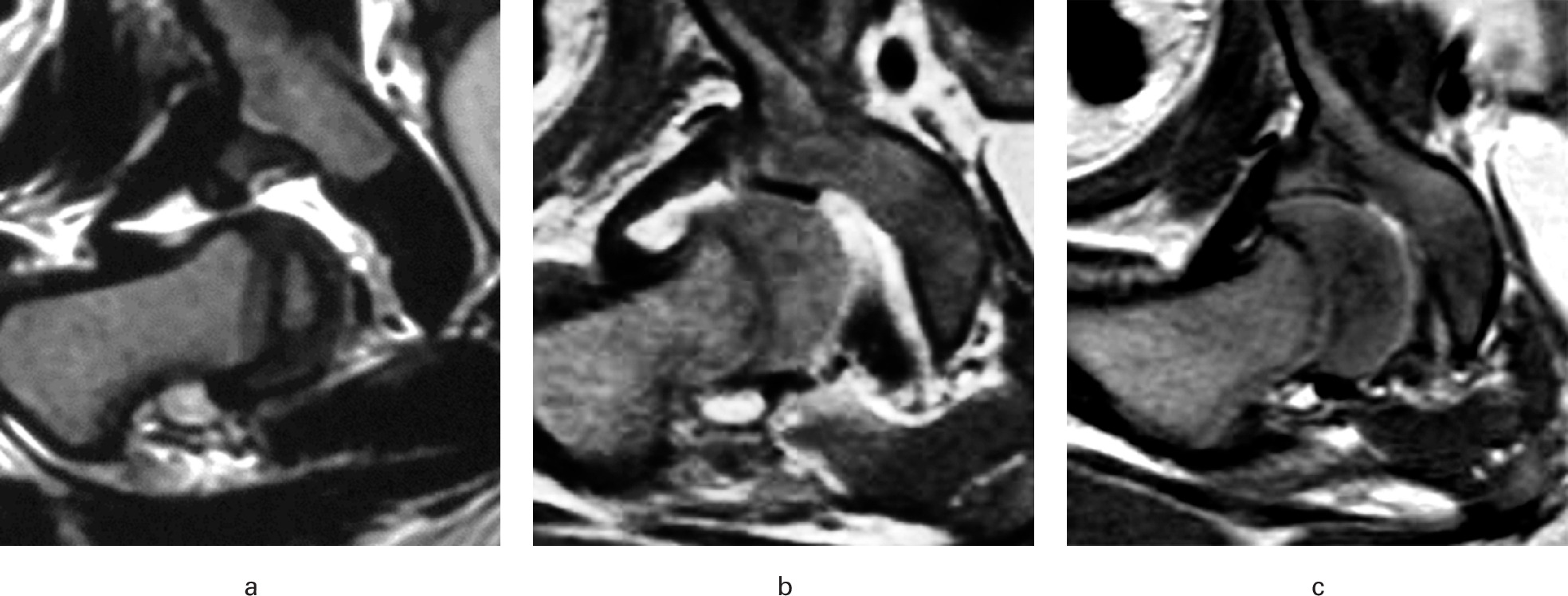Fig. 3 
            Labrum-acetabular cartilage complex (LACC) morphology (except inverted type) on MRI scans immediately after initial reduction. a) Everted LACC: the cartilage was everted without inverted labrum. b) Partly inverted LACC: the cartilage was everted with inverted labrum. c) Partly inverted LACC (overriding type): the entire LACC was divided into an inverted part and an everted part.
          
