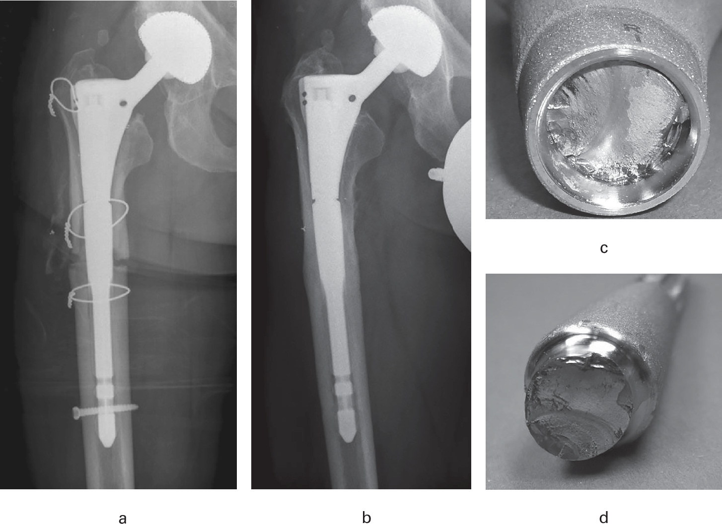 Fig. 3 
            a) Anteroposterior radiograph of Patient #23 (male, aged 60 years) after implantation of a Prevision hip stem 240 mm curved (original taper design). b) Radiograph of the fractured hip stem after seven years. c) Proximal and d) distal fracture surfaces of the modular taper. Images of fracture surfaces reprinted with kind permission from Michael Morlock.
          
