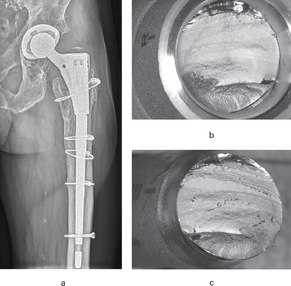 Fig. 4 
            a) Anteroposterior radiograph of Patient #26 (male, aged 61 years at time of radiograph) after fracture of a Prevision hip stem straight 280 mm six years after implantation. b) Proximal and c) distal facture surfaces of the modular taper. Radiographs of the patient before failure were not available from the reporting clinic.
          