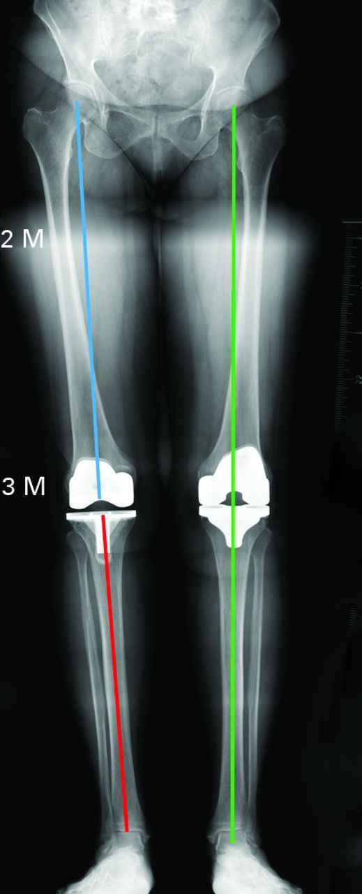 Fig. 1 
          Radiograph showing the femoral
mechanical axis (blue line), tibial mechanical axis (red line) and
mechanical alignment (green line).
        