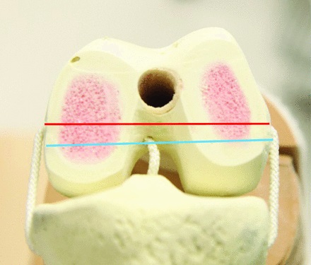 Fig. 2 
          A sawbone model of the distal femur
illustrating the relationship between the trans--epicondylar axis
(red line) and flexion-extension axis (blue line) after Eckhoff
et al.17
        