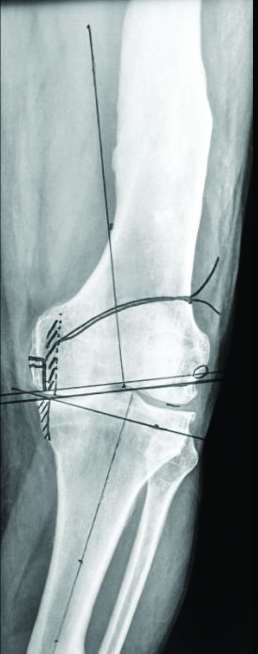 Figs. 3a - 3d 
          Radiographs showing a) severe
varus knee with extra-articular deformities of the femur and tibia
after fracture malunions; b) anteroposterior (AP) view of the pre-operative
plan of the femoral and tibial resections. Planning of medial tibial bone
resection and epicondylar osteotomy is shown; c) post-operative
AP long-film with correction of the malalignment with a posterior-stabilised
total knee arthroplasty. The ligamentous balance has been achieved
with subperiosteal release of the deep medial collateral ligament
(MCL) and semimembranosus, release of the posterior fibres of the
superficial MCL and fine tuning the final balance with needle puncturing
(16G needle) of the deep and superficial MCL; and d) post-operative
lateral view of the knee. EA def, extra-articular deformity.
        