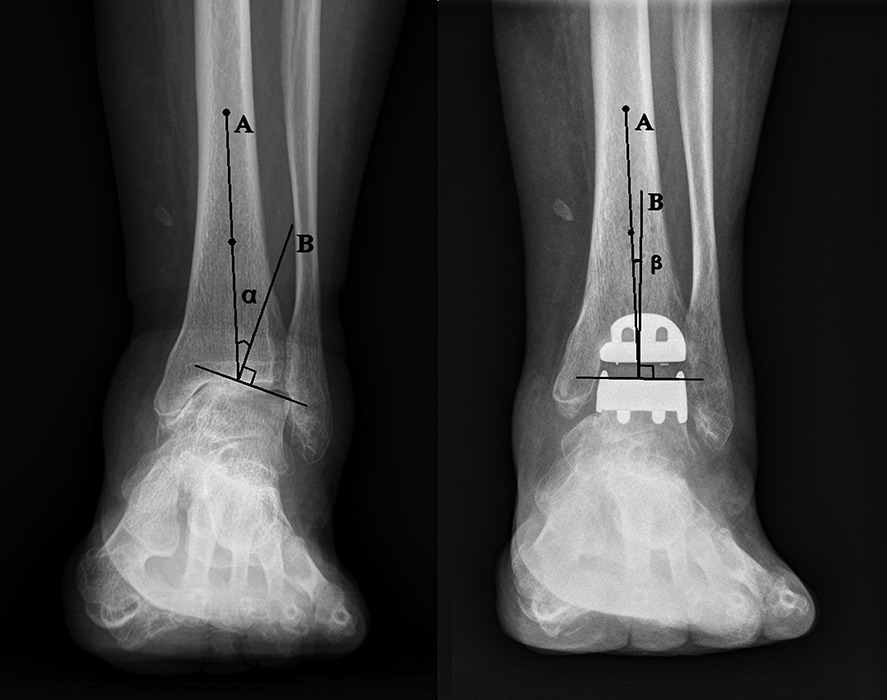 Fig. 1 
            Radiographs showing the anatomical axis
of the tibia (A), which coincides with the mechanical axis of the
normal tibia, is defined as a line connecting the centre of the
cortex of the tibia at 5 cm and 10 cm proximal to the tibial plafond.
The angle (α) between the anatomical axis of the tibia and the line
drawn perpendicular to the talar dome (B) on the pre-operative weight-bearing
anteroposterior view of the ankle was defined as the pre-operative
coronal plane alignment of the ankle joint. Angular position of
the implants is also measured on the weight-bearing anteroposterior
view. The angle (β) between the anatomical axis of the tibia (A)
and the line drawn perpendicular to the talar component (B) was
defined as the post-operative coronal plane alignment angle of the
ankle joint.
          