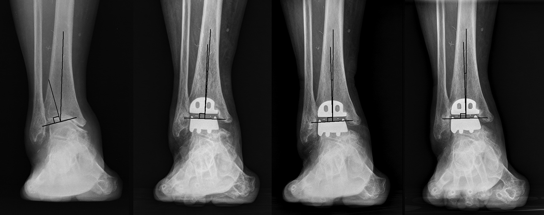 Fig. 2 
            A patient with a post-traumatic ankle
osteoarthritis with incongruent severe varus deformity (tibiotalar
angle 17° varus). Pre-operative, one, three, and five years (left
to right) post-operative standing anteroposterior radiographs were
made.
          