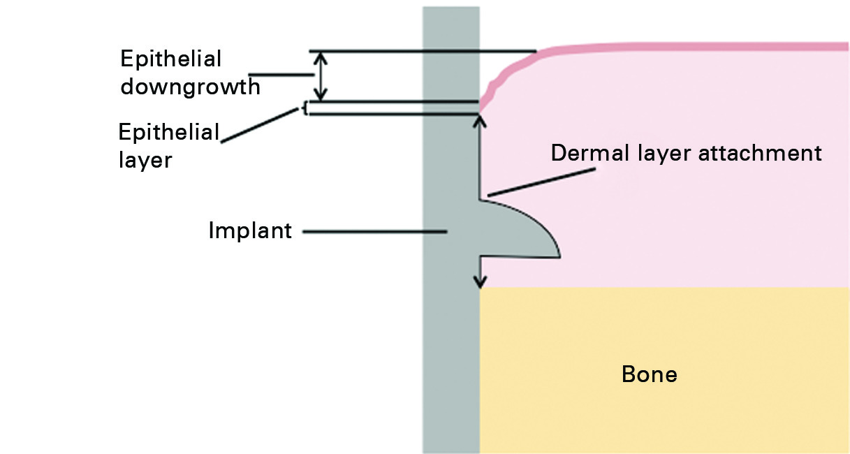 Fig. 2 
            Schematic diagram showing the measurements
for epithelial downgrowth, epithelial and subepithelial attachment
for a flanged implant.
          