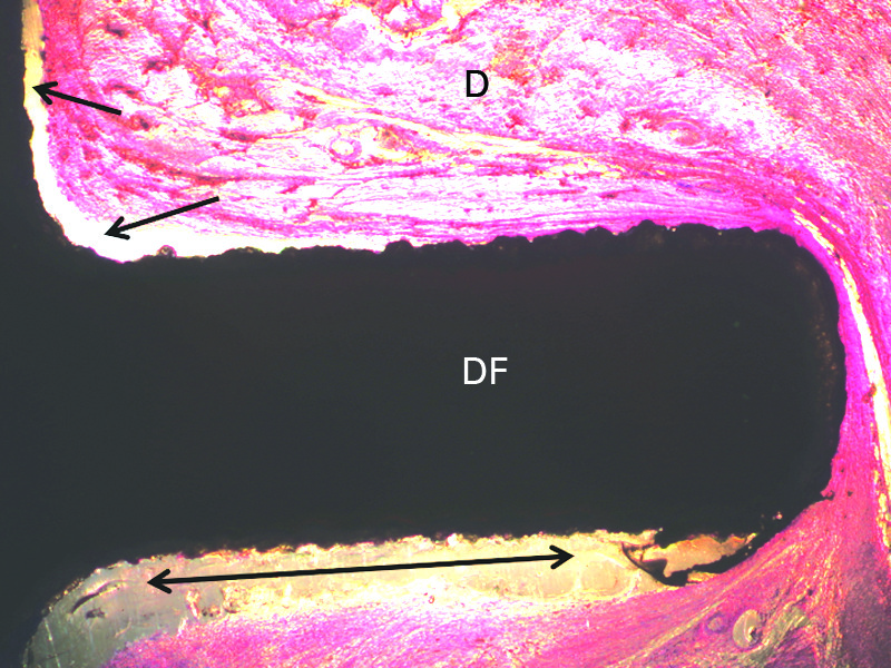 Figs. 5a - 5d 
            Histological sections showing
(a) incomplete soft-tissue fill within a drilled flange (DF) pore
(P); (b) areas of lack of the dermal tissue (D) attachment to the
flange of a DF implant (arrows); (c) intimate contact between uncoated porous
titanium alloy flange (PT) pore edges and soft-tissue PT. Increased
collagen deposition is seen at the pore periphery and (d) the dermis
attaching to hydroxyapatite with fibronectin coated flange flange.
          