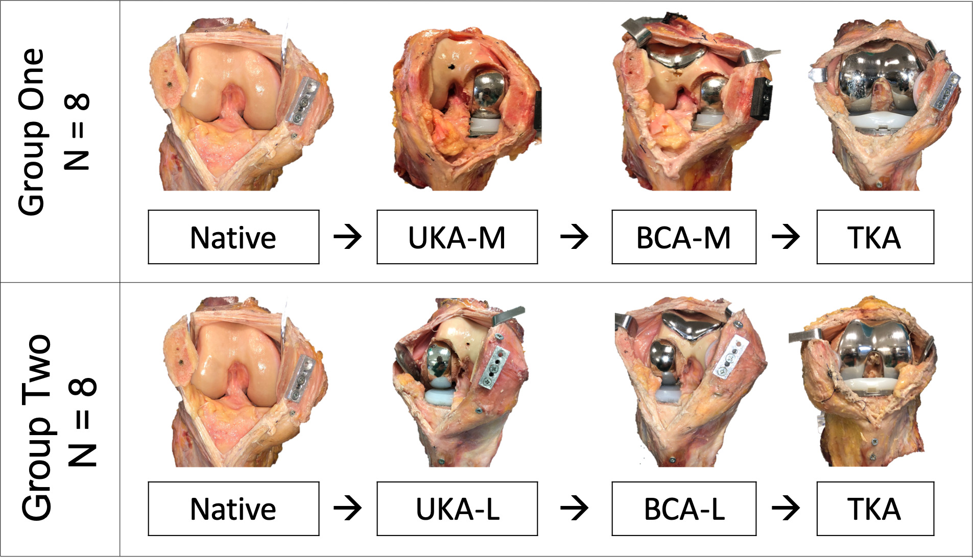 Fig. 2 
            Arthroplasty sequences for Groups 1 and 2: medial unicompartmental knee arthroplasty (UKA-M), medial bicompartmental arthroplasty (BCA-M), lateral unicompartmental knee arthroplasty (UKA-L), lateral bicompartmental knee arthroplasty (BCA-L), and posterior-cruciate retaining total knee arthroplasty (TKA).
          