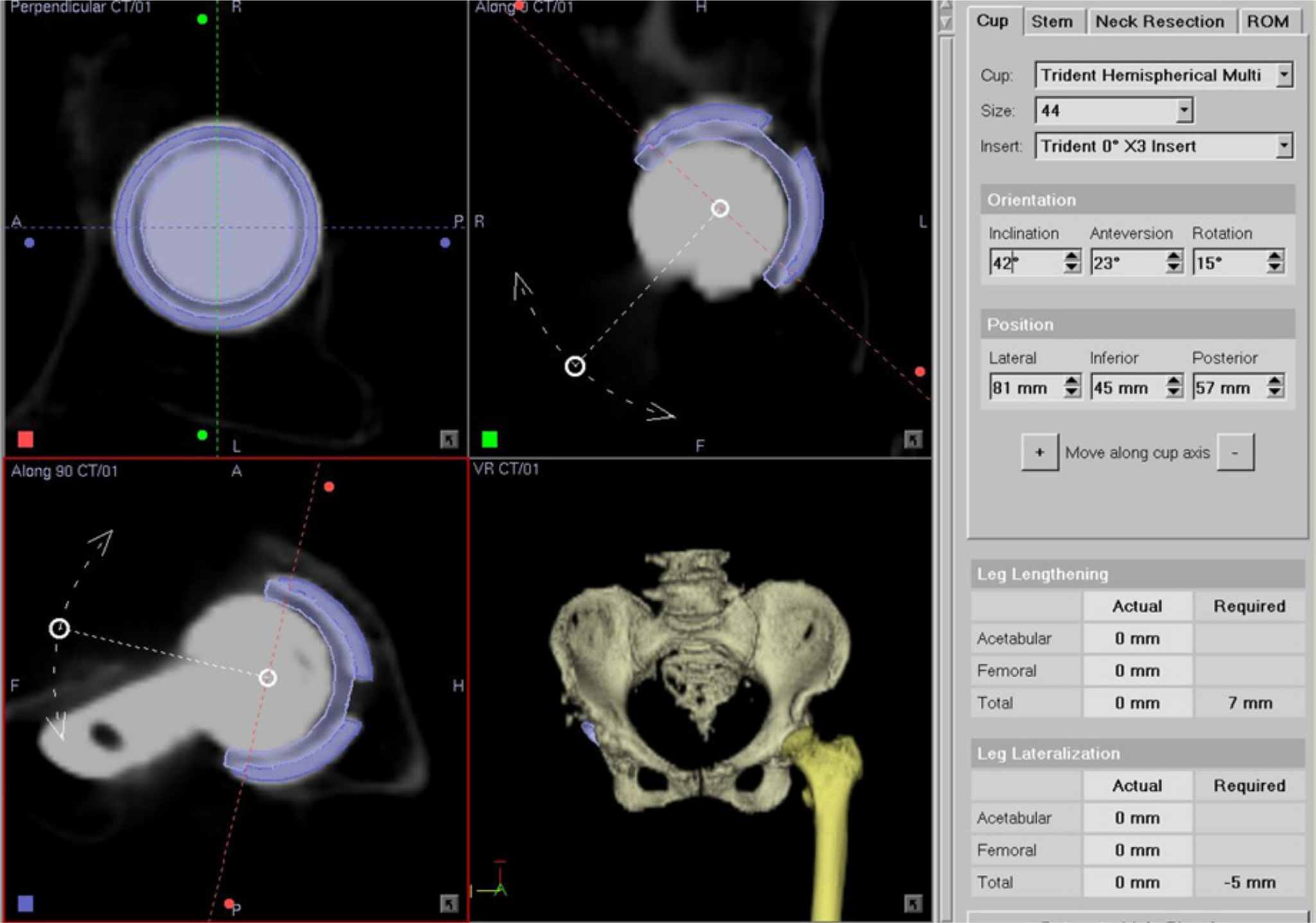 Fig. 1 
            Acetabular component angles were measured by OrthoMap 3D workstation, superimposing the templates of the acetabular component on the postoperative image of the acetabular component. ROM, range of motion.
          