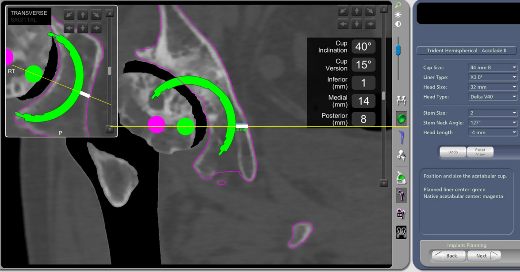 Fig. 2 
            Preoperative cup positions were measured on the MAKO workstation. White lines indicate the distance between the outer edge of the cup and the medial edge of the acetabulum on axial and coronal view. P, posterior; RT, right.
          