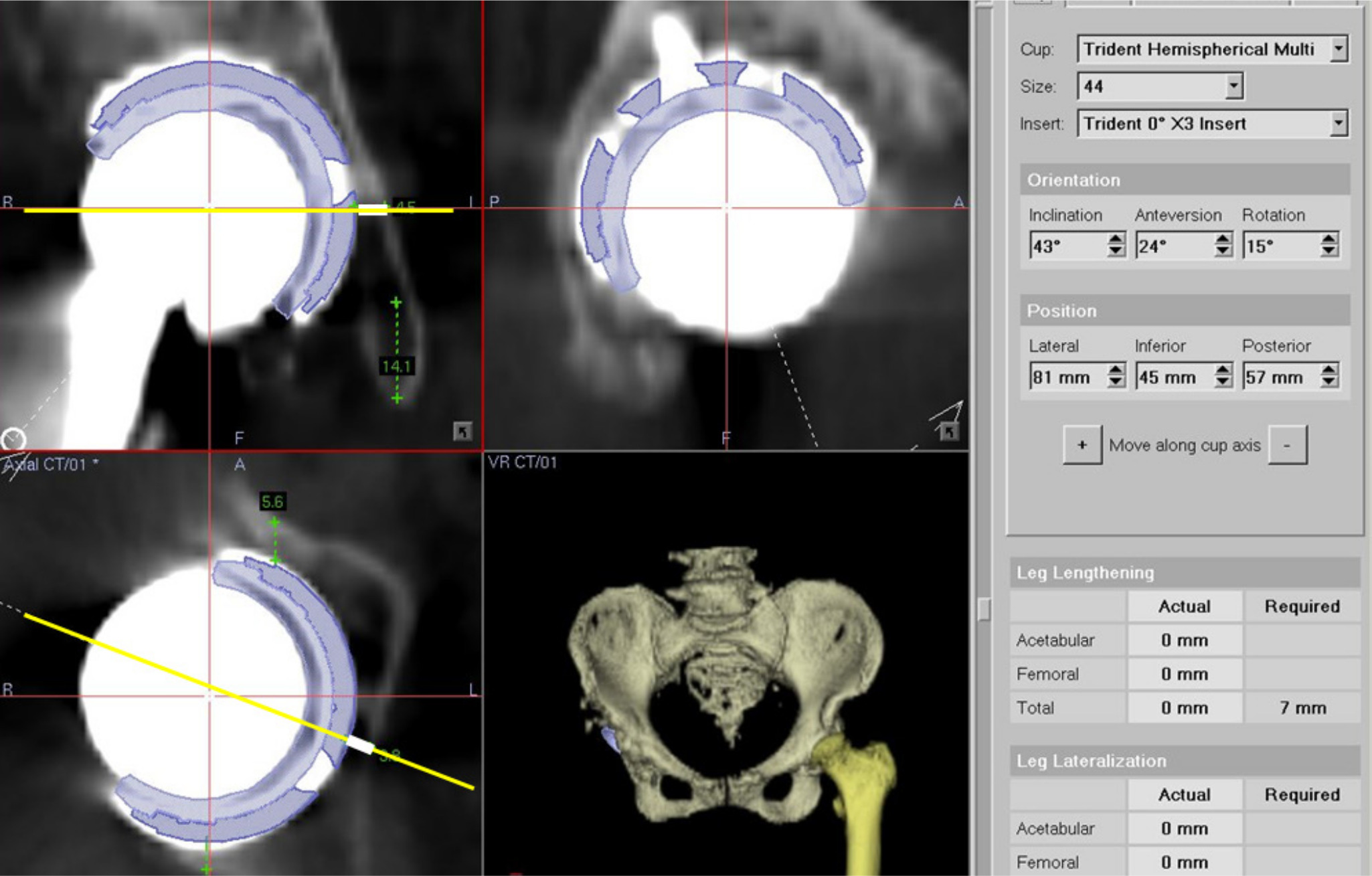 Fig. 3 
            Postoperative cup positions were measured on the OrthoMap 3D workstation. White lines indicate the distance between the outer edge of the cup and the medial edge of the acetabulum on axial and coronal view.
          