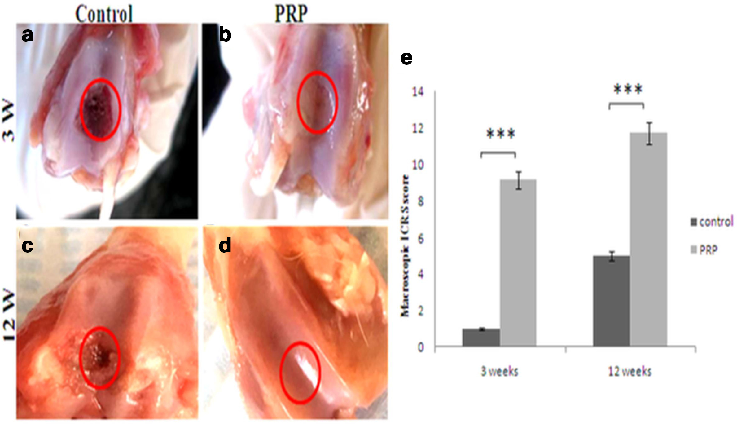 Fig. 2 
            Representative photographs of gross appearance of defect in trochlear groove (4 mm in diameter) at: a) and b) week 3; c) and d) week 12. a) and c) controls; b) complete restoration of the articular surface of the defect; d) similar appearance to the normal cartilage. The red circles indicate the original defect margin. e) Macroscopic assessment of cartilage repair was assessed by International Cartilage Repair Society (ICRS) macroscopic evaluation scale. Results are presented as the mean and standard deviation (SD); statistical analysis was performed to compare scores of treated and control groups. ***p < 0.05, non-parametric Wilcoxon signed-rank test. Control, untreated group; platelet-rich plasma (PRP), group treated with PRP.
          
