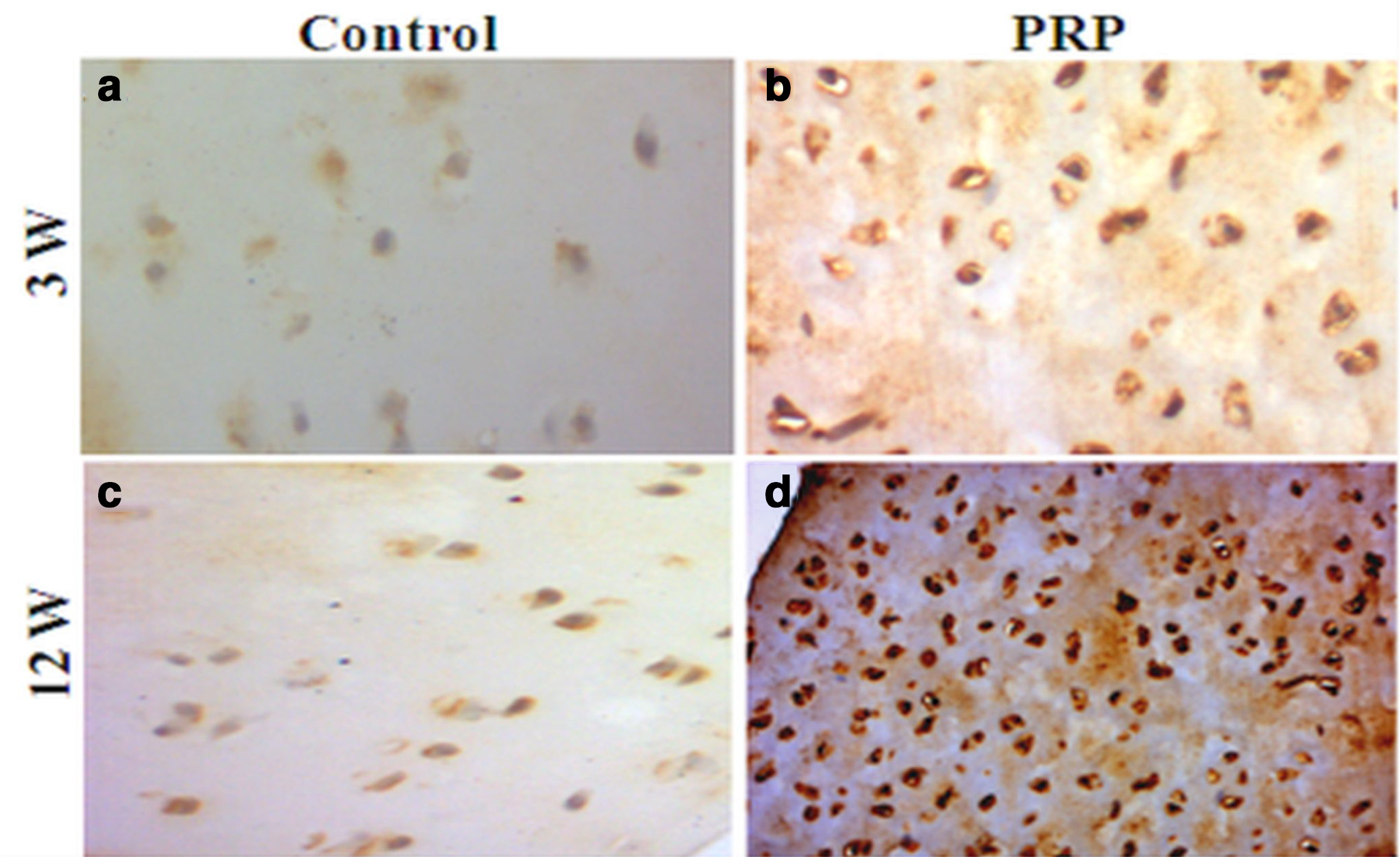 Fig. 7 
            Photomicrograph showing immunohistochemical staining for type II collagen at: a) and b) week 3; c) and d) week 12. a) and c) control absence of collagen II expression; b) very low amount of collagen II; d) considerable amount of collagen II. Original magnification: 200×. PRP, platelet-rich plasma.
          