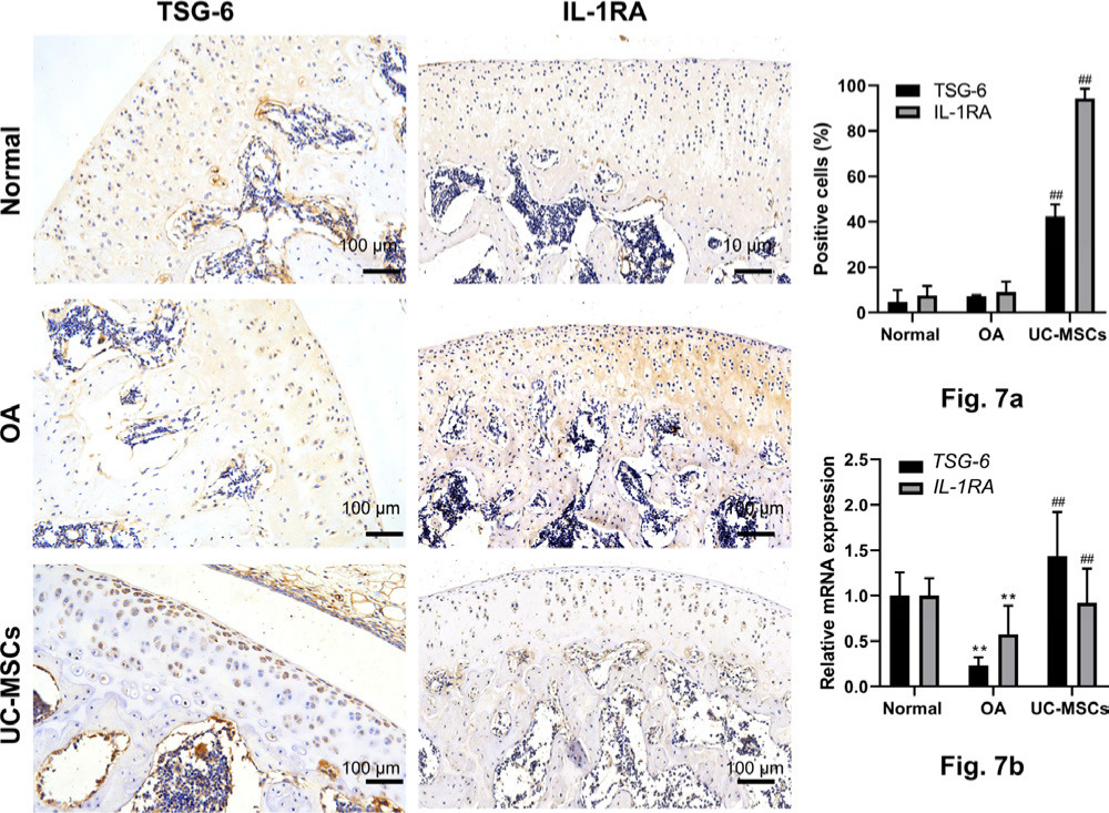 Fig. 7 
            Human umbilical cord mesenchymal stem cells (UC-MSCs) enhanced the expression of tumour necrosis factor-α-induced protein 6 (TSG-6) and interleukin-1 receptor antagonist (IL-1RA) in monosodium iodoacetate (MIA)-induced osteoarthritis (OA) cartilage. a) The expression of TSG-6 and IL-1RA in the articular cartilage was determined by immunostaining and analyzed with the percentage of positive cells. b) The expression of TSG-6 and IL-1RA was further confirmed by quantitative real-time polymerase chain reaction. Data represent mean and standard deviation. **p < 0.01 versus normal group, ##p < 0.01 versus OA group. mRNA, messenger RNA.
          