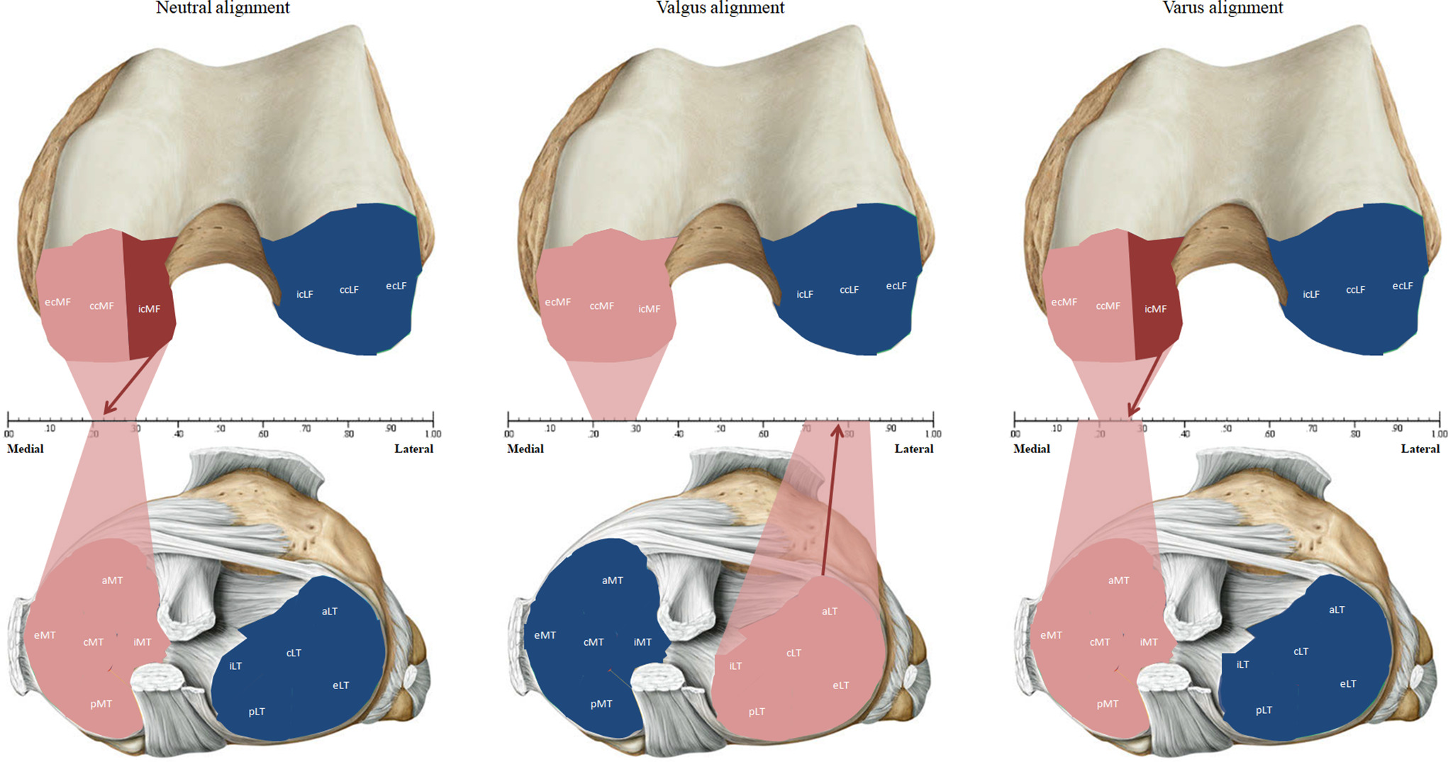 Fig. 5 
          Data derived from Table I show the analyzed subregions at the tibia (lower section) and the femur (upper section) with highlights of specific areas of high correlation between cartilage volume loss and its corresponding (x)-specific location. Colour-coded correlations: Blue area, subregion with low statistical correlation (r < 0.7); pink area, subregion with high statistical correlation (r ≥ 0.7); red area, subregion with highest statistical correlation in its alignment group; arrow, (x)-location with highest statistical correlation in its alignment group. aLT, anterior lateral tibia; aMT, anterior medial tibia; ccLF, central lateral femur; ccMF, central medial femur; cLT, central lateral tibia; cMT, central medial tibia; ecLF, external central lateral femur; ecMF, external central medial femur; eLT, external lateral tibia; eMT, external medial tibia; icLF, internal central lateral femur; icMF, internal central medial femur; iLT, internal lateral tibia; iMT, internal medial tibia; pLT, posterior lateral tibia; pMT, posterior medial tibia.
        