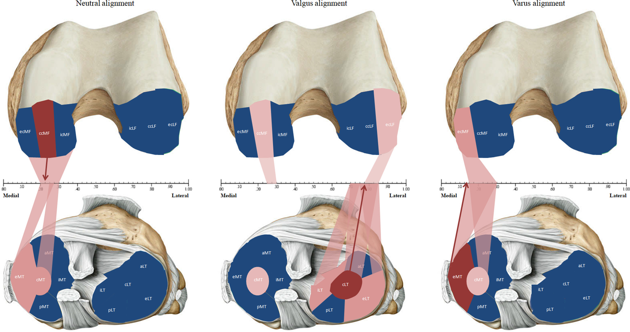 Fig. 6 
          Data derived from Table II show the analyzed subregions at the tibia (lower section) and the femur (upper section) with highlights of specific areas of high correlation between cartilage thickness loss and its corresponding (x)-specific location. Colour-coded correlations: Blue area, subregion with low statistical correlation (r < 0.7); pink area, subregion with high statistical correlation (r ≥ 0.7); red area, subregion with highest statistical correlation in its alignment group; arrow, (x)-location with highest statistical correlation in its alignment group. aLT, anterior lateral tibia; aMT, anterior medial tibia; ccLF, central lateral femur; ccMF, central medial femur; cLT, central lateral tibia; cMT, central medial tibia; ecLF, external central lateral femur; ecMF, external central medial femur; eLT, external lateral tibia; eMT, external medial tibia; icLF, internal central lateral femur; icMF, internal central medial femur; iLT, internal lateral tibia; iMT, internal medial tibia; pLT, posterior lateral tibia; pMT, posterior medial tibia.
        
